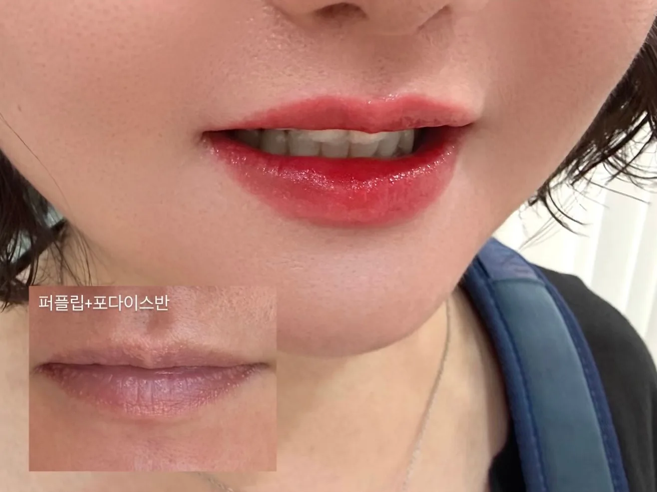 입술반영구 시술 후 — 퍼플립 톤 보정, Before 인컷 포함