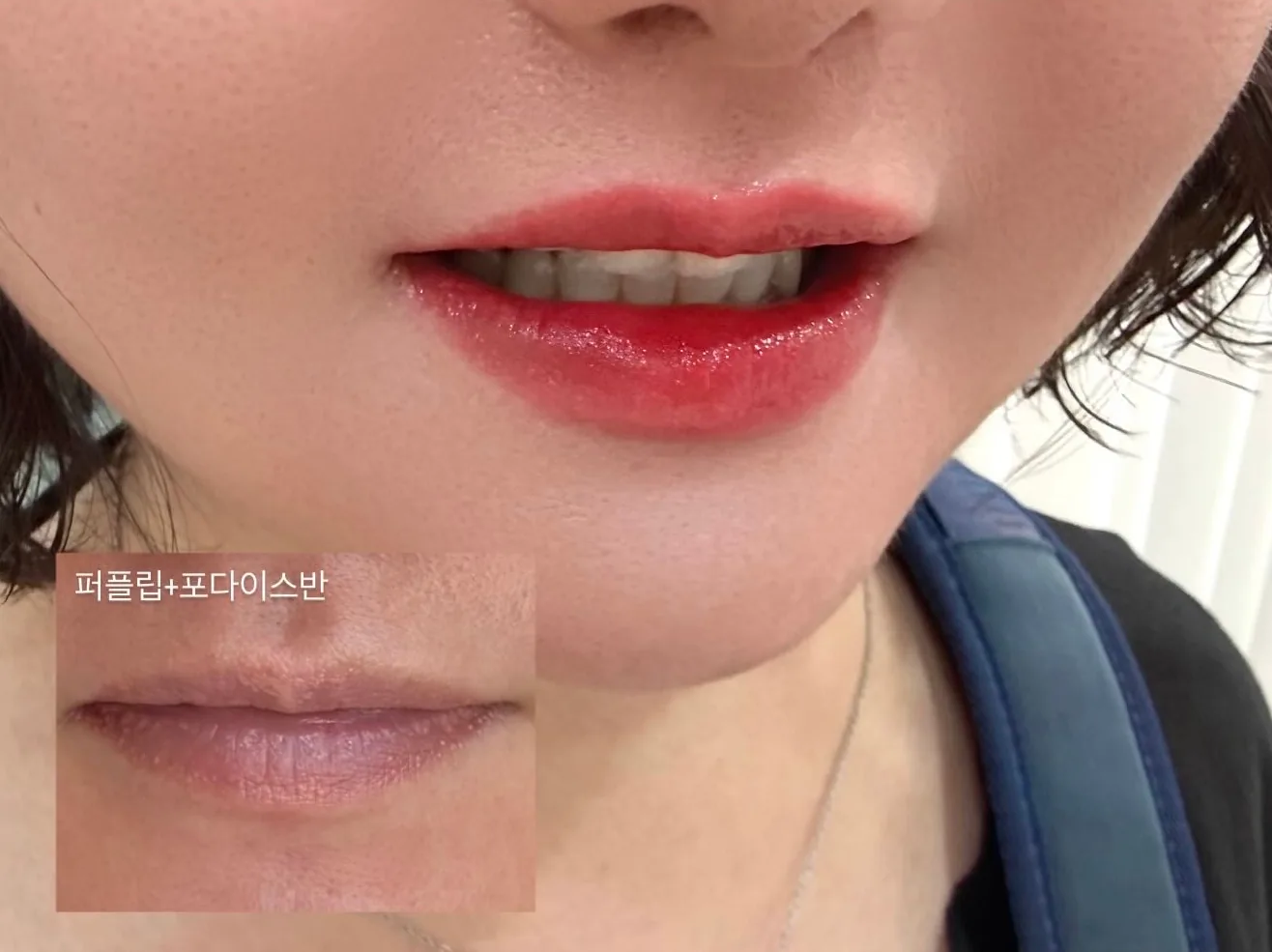 입술반영구 시술 후 — 퍼플립 톤 보정, Before 인컷 포함