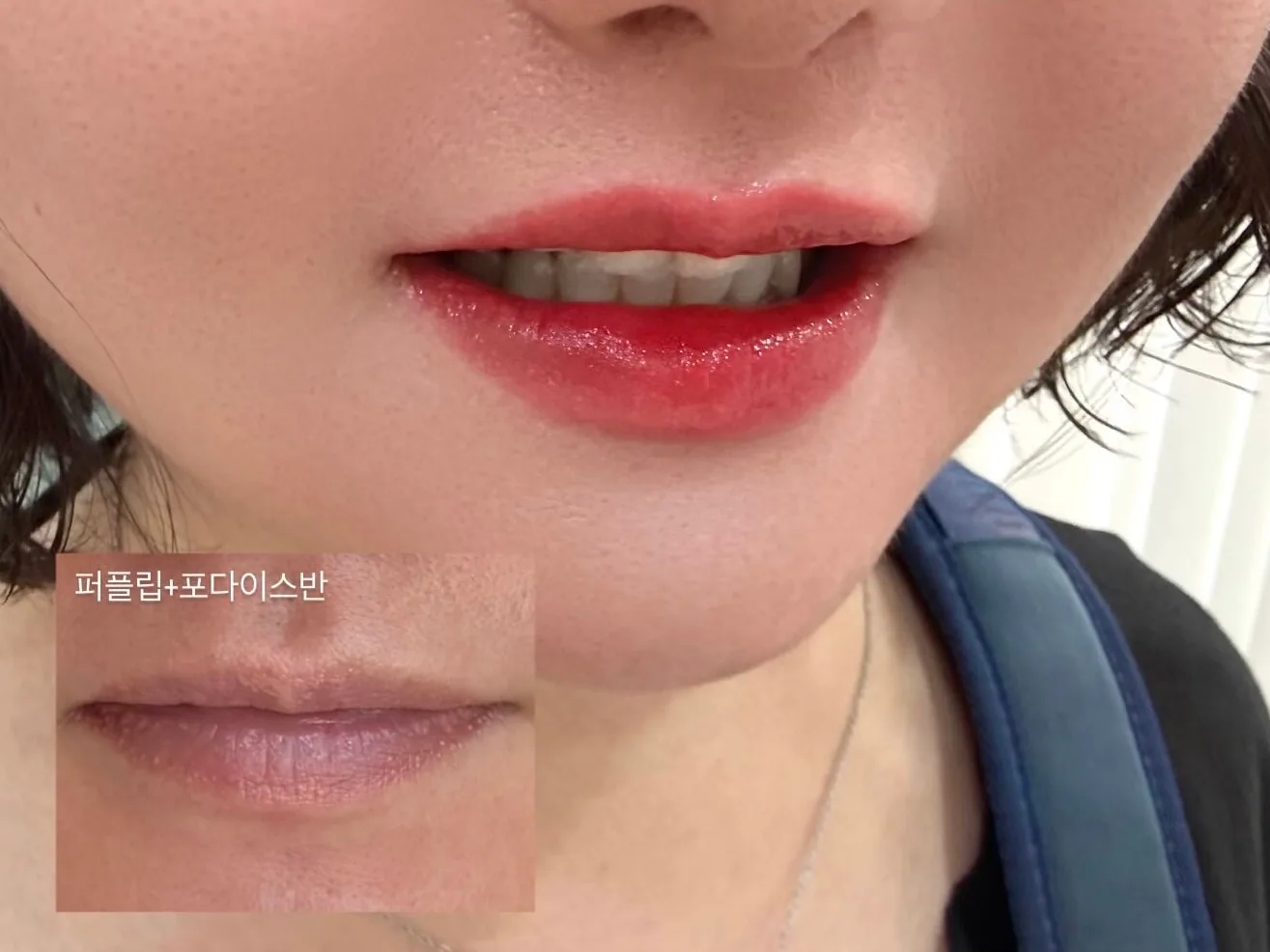 입술반영구 시술 후 — 퍼플립 톤 보정, Before 인컷 포함